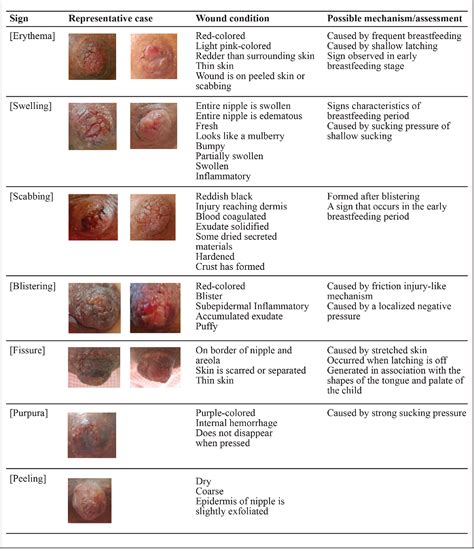 Areola Abnormalities